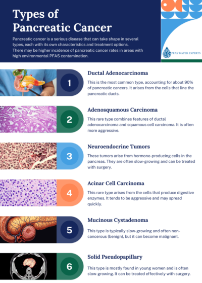 types of pancreatic cancer
