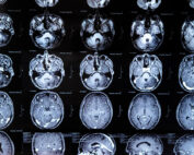 pfas and brain cancer