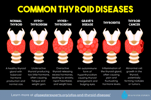 common thyroid diseases